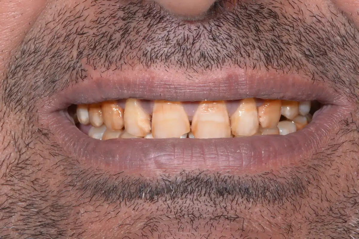 Avant blanchiment laser Tunisie – dents jaunies tachées patient VIP Smile